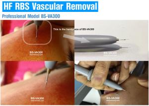 China Professional Vascular Removal Machine , Spider Vein Removal Machine High Frequency factory