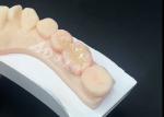 Emax Ceramic Inlays Onlays Dental Restorations For Natural Tooth Color And Easy