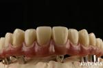 Titanium Malong Dental Hybrid Bridge Long Lasting Adjusted Fit Low Density