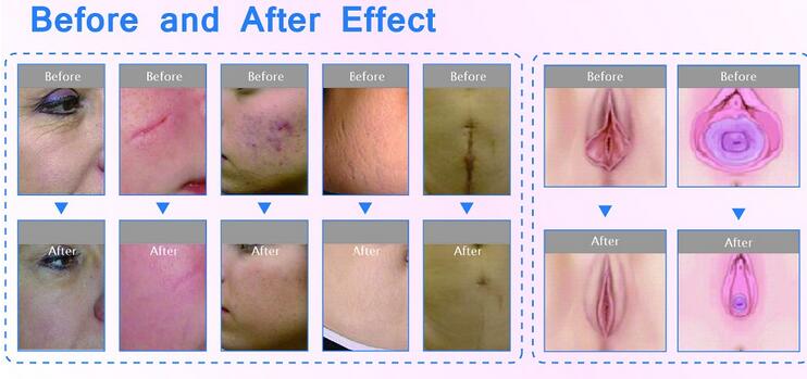 Fractional Co2 fractional Laser vaginal tightening acne scar removal machine