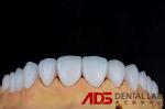 OEM Veneers Dental E-Max Crowns Stain Resistance Minimally Invasive