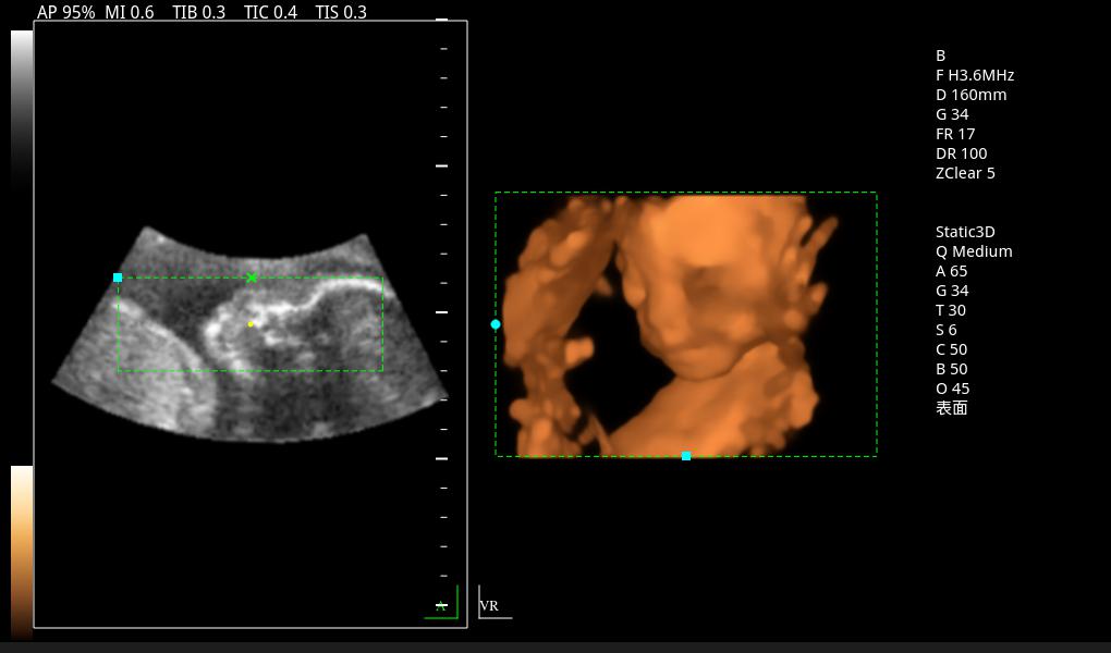 Zoncare 3D/4D Trolley Medical Digital Color Doppler Ultrasound System for Hospital