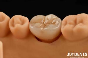 China Natural-looking Multilayer Full Zirconia For High Strength And Durability factory