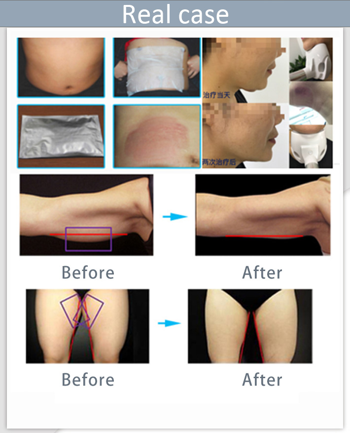 DM-55-1 Skin Tightening 360 Cryolipolysis Slimming Machine 50KHZ Anti Cellulite