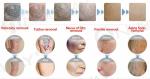 1064nm 532 nm 1320nm Q Switched Nd Yag Laser Machine :Pigment removal,Tattoo