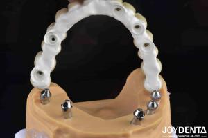 China High Strength Ti-Base Hybrid Zirconia Bridge Fracture Resistance Dental Solution factory
