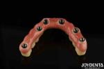 Low Density Titanium Malong Hybrid Bridge Dental Light Weight Comfortable Wear