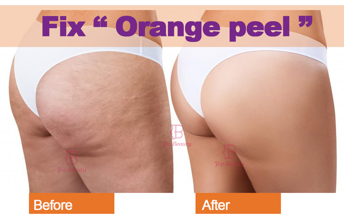 Cellulite Reduction Skin Toning Body Contouring Therapy Machine