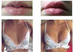 Breast Enlargement Injection Filler Hyaluronic Acid Implant Lip Injections