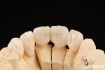 Highly Customizable Layered Zirconia Dental Crowns And Bridges Long Lasting