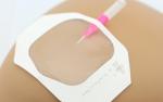 Transparent iv cannula dressing