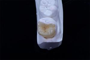 China Dental Crown Composite Inlays And Onlays Restoration Customized Shape factory