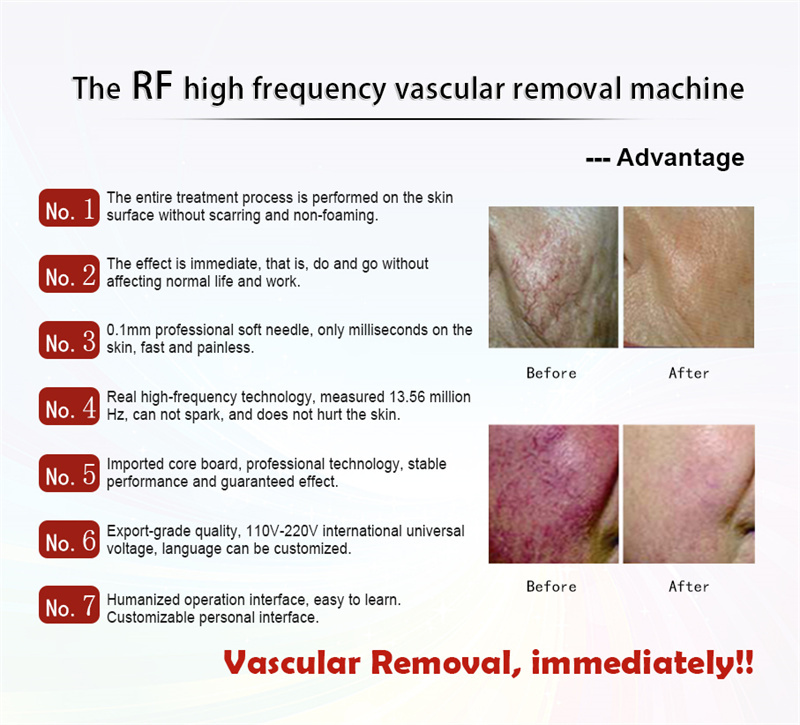Painless Vascular Laser Spider Vein Removal Machine Diode Portable 980nm 60W