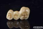 High Biocompatibility Zirconia Full Contour Crown Perfect Fit High Strength