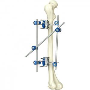 China Excellent Quality Instrument Orthopedic Tibia & Percone External Fixator Orthopedic Surgical Instruments factory