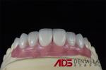 Long Lasting Permanent White Dental Porcelain Veneers Stain Resistance