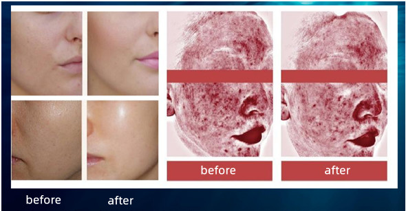 Injectable Pdrn 3ml Hyaluronic Acid Skin Booster Complex Solution Injection