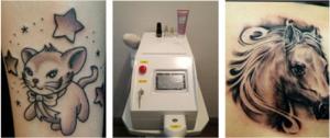 China Mini Portable Nd yag 1064nm laser/Q-switch Nd yag laser tattoo removal machine factory