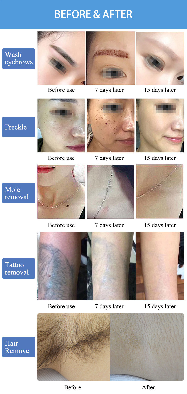 12 Inch Touch Screen 755/1064/532/1320nm Picosecond Laser Machine For Tattoo Pigmentation Removal