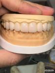 16 Shades Color Emax Dental Veneers A1-A4 High Stain Resistance For Perfectly