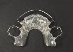 Hawley retainer Orthodontic Appliances for Comfortable Teeth Alignment