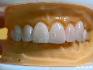 China Lightweight and Smooth Dental Veneers Stain Resistance Long-lasting Durability for Optimal Comfort factory
