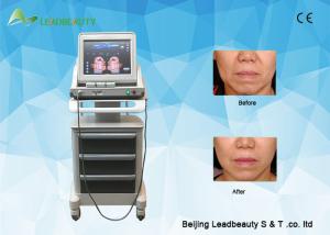 China High Intensity Focused Ultrasound face lifting wrinkle removal skin factory