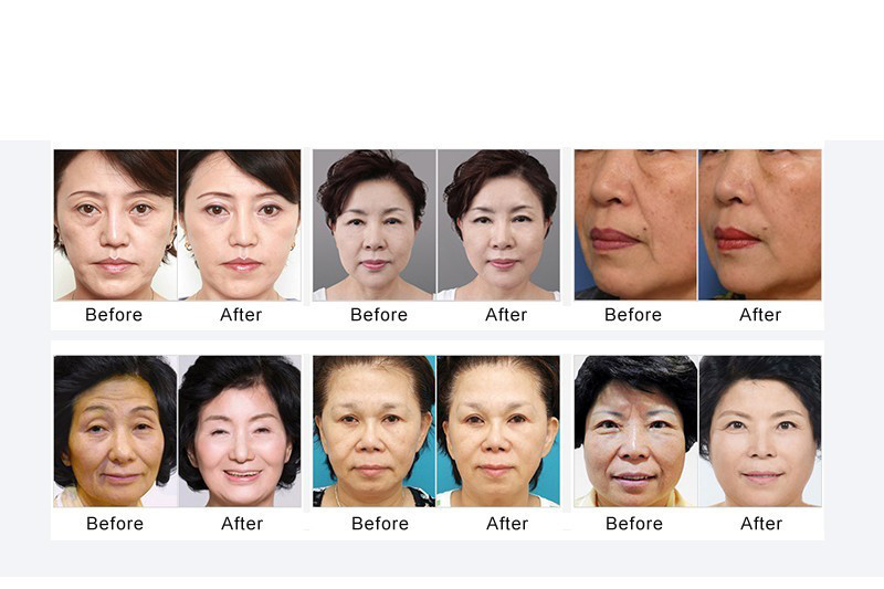 Body Firming 7D HIFU 12D HIFU Machine Facial Ultrasound Non Surgical