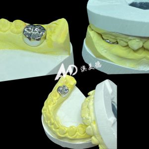 Metal Titanium Crown Precision Strength and Biocompatibility for Lasting