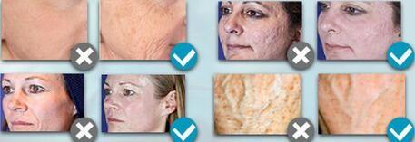 2016 Hot sale !!! Best effective co2 fractional laser skin resurfacing machine