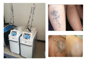 China CE Approved ND YAG Laser Tattoo Removal Machine For Laser Pigmentation Removal factory