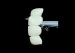 Natural-Looking Zirconia Ceramic Crown Bridge Provides Precision And Aesthetics
