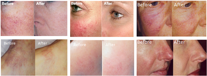 Safe 980 Spider Vein Removal Machine , Diode Laser Equipment For Rosacea Removal