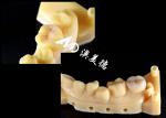 Precision Ceramic Inlays and Onlays for Teeth Repair with Natural Color
