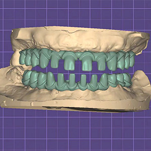 Pure Titanium Malo Bridge Customizable Silver Metal Frame Teeth