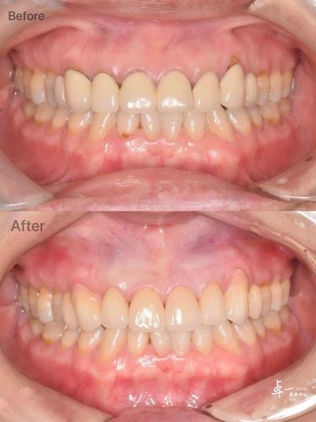 High Fracture Resistance Dental Zirconia For Safe Oral Tissue And CAD / CAM