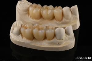 China Wear Resistant Zirconia Full Contour Dental Crown High Translucency factory