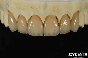 China Excellent Biocompatibility Layered Zirconia Within High Aesthetics And Density 6.0-6.1 G/cm3 factory