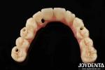 Hybrid Technology Titanium Malong Dental Bridge Adjustable For Aesthetic Results