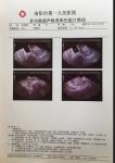 Single Side Printing 0.10Mm Laser X Ray Film For Hospital
