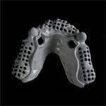 Removable Telescopic Partial Denture China Dental Lab For Missing Teeth