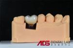 Dental Missing Teeth Cement Retained Implant Crown Replacement Custom