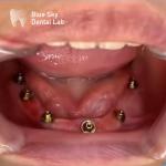 Nature Design Dental Implant Case Implant Operation Cases For Multiple Choices