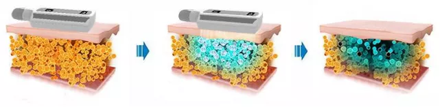 T Shock Cryolipolysis Slimming Machine Thermal Multifunction Cryolipolysis Machine