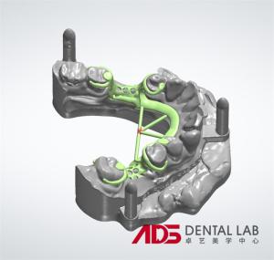 China Concealed Metal Cast Frame Partial Denture Framework Partial Full Arch factory