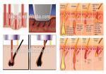 2000w 950nm Permanent IPL Hair Removal Machine
