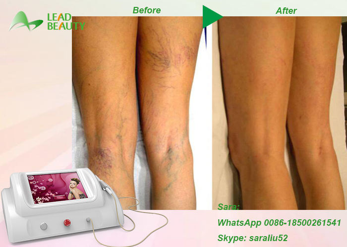 Professional high frequency vascular removal machine for sale