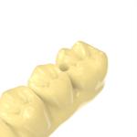 Natural Temporary Crown And Bridge Resin Dental LCD Printer Resin