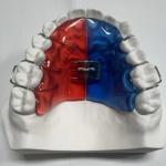 Stainless Steel Acrylic Screw Expander Orthodontic Treatment Removable