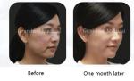PCL Polycaprolactone Hyaluronic Acid Filler Medical Beauty Injection Collagen